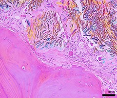 03 -Ashika Chhana 1_Gouty bone erosion in human joint_polarised light-200px