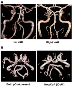 cerebral arteries cerebral arteries